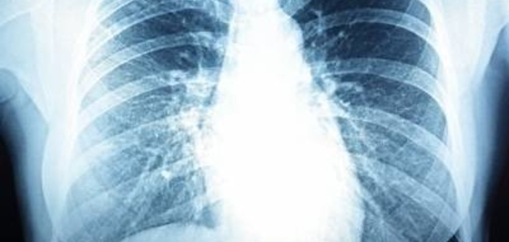 New Support for victims of "mesothelioma".