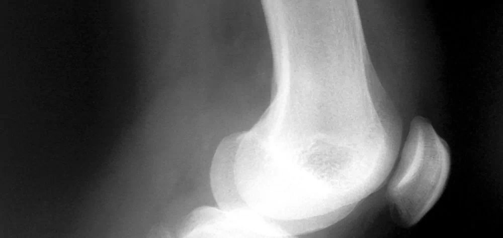 Banner Jones secures £2.8m award for Highways Officer who suffered devastating injuries following a road traffic accident